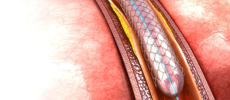 cardiac stent