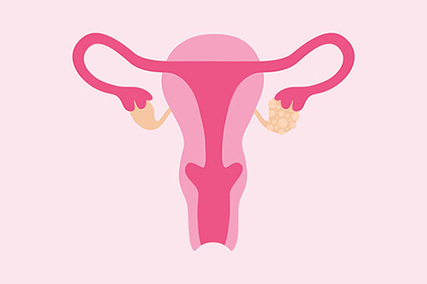 PCOS uterus