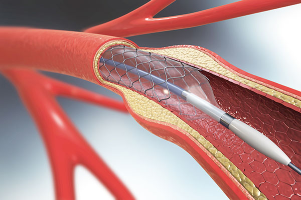 artery stent