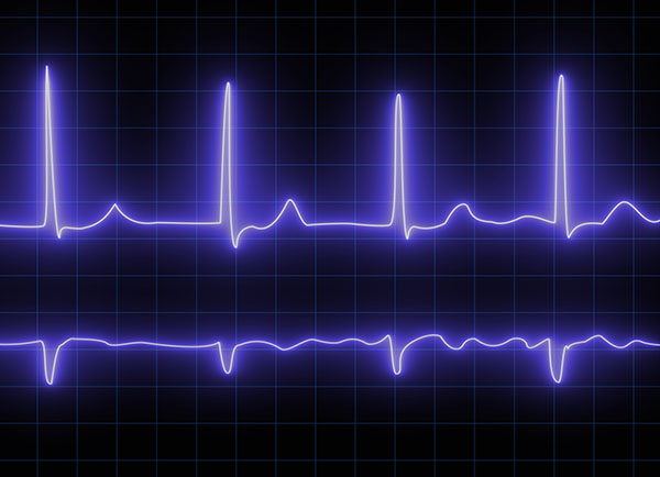 Afib ECG