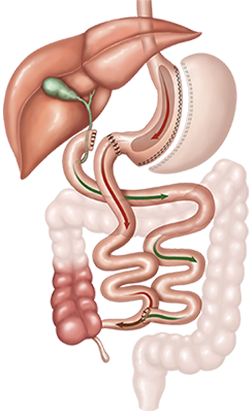 duodenal switch