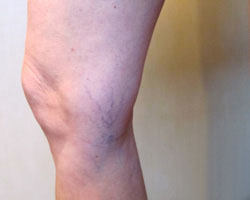 leg before vein treatment