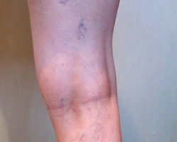 leg before vein treatment