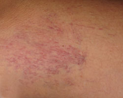 thigh before vein treatment