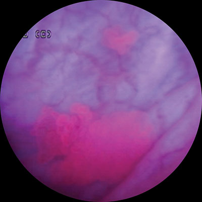 blue light cystoscopy