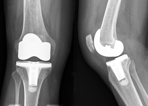 knee replacement