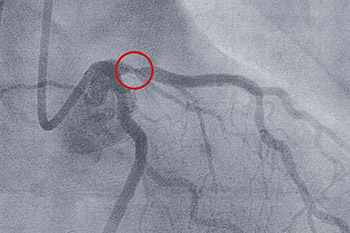 stent arteries