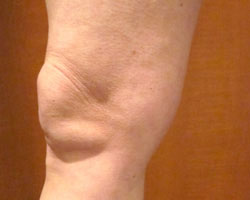 leg after vein treatment