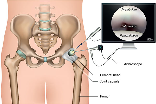 hip arthroscopy