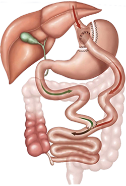 duodenal switch