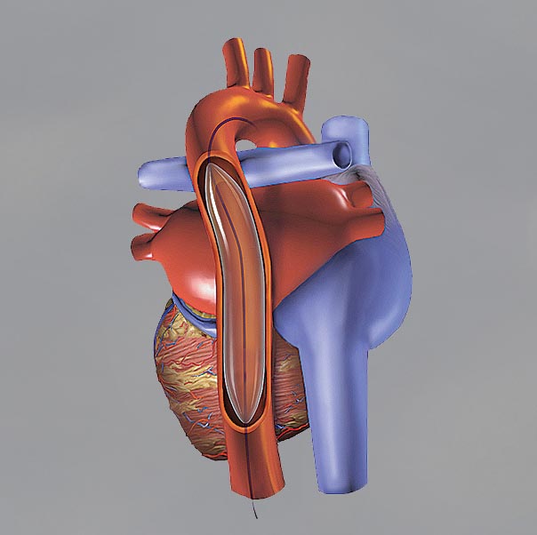 intraaortic balloon