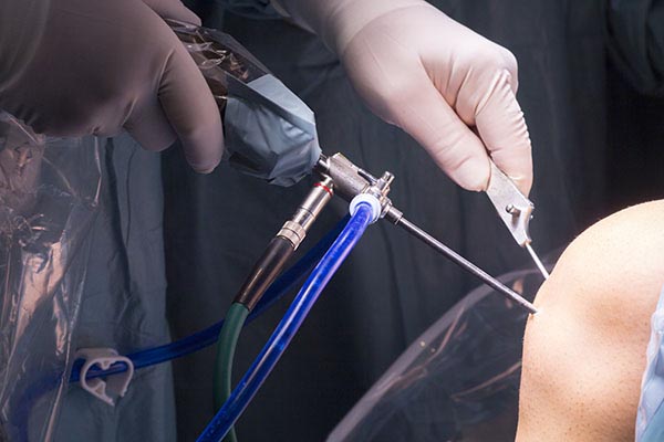 knee arthroscopy