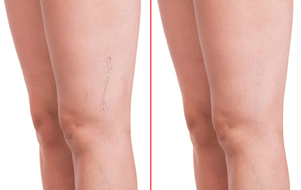 vein before and after