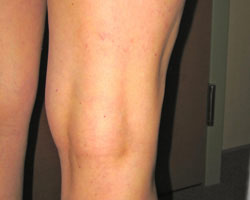 leg after vein treatment