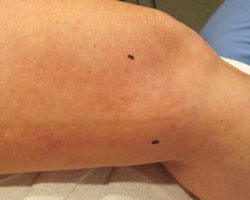 thigh after vein treatment